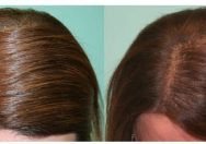 hair surgery for women
