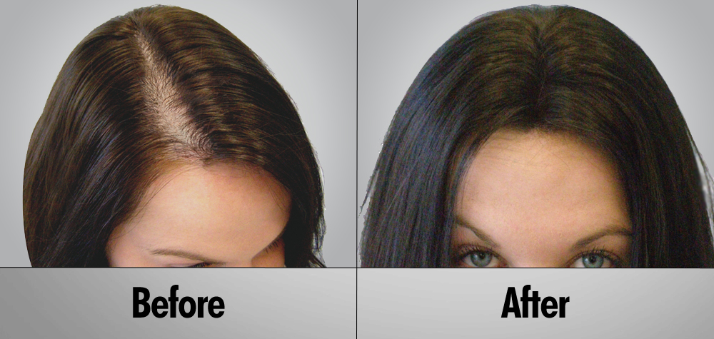 hair surgery for women