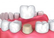How To Choose A Dental Crown?